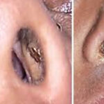 Why You Keep Getting Pimples Inside Your Nose, and What to Do About it[