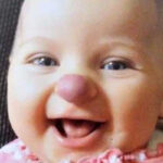 9 years ago, a young girl was born with a distinctive “clown nose”: look ather current appearance after so many years