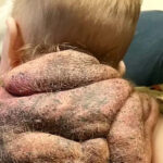 My ‘Ninja Turtle baby’ boy was born with a shell — he’s my superhero